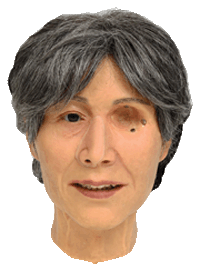 Before fitting the ocular prosthesis